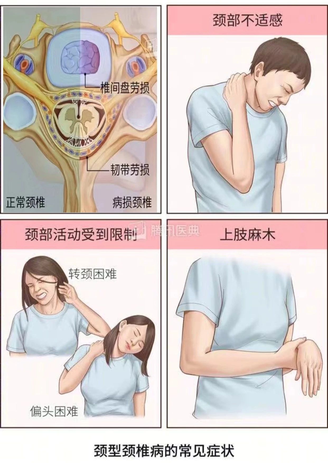 颈型颈椎病.jpg